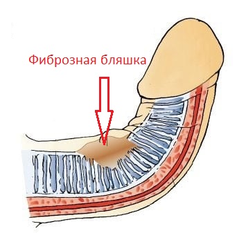Как выглядит Фиброзная бляшка полового члена